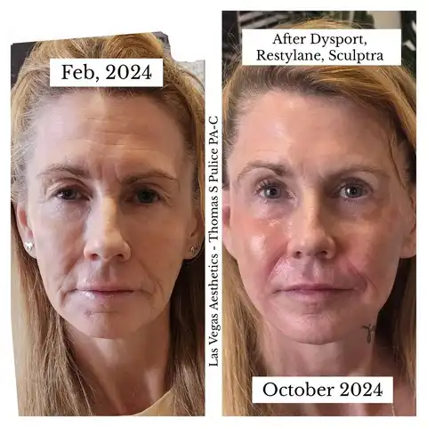 Dysport, Restylane, and Sculptra before and after Las Vegas — February to October 2024 showing lifted midface, reduced deep lines, and improved skin smoothness at Las Vegas Aesthetics by Thomas Pulice PA-C