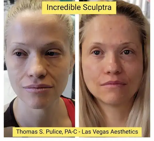 Sculptra incredible before and after Las Vegas — dramatic facial volume restoration and collagen stimulation at Las Vegas Aesthetics by Thomas Pulice PA-C
