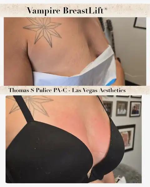 Vampire Breast Lift before and after Las Vegas — improved breast shape and fullness with PRP, Thomas Pulice PA-C Las Vegas Aesthetics