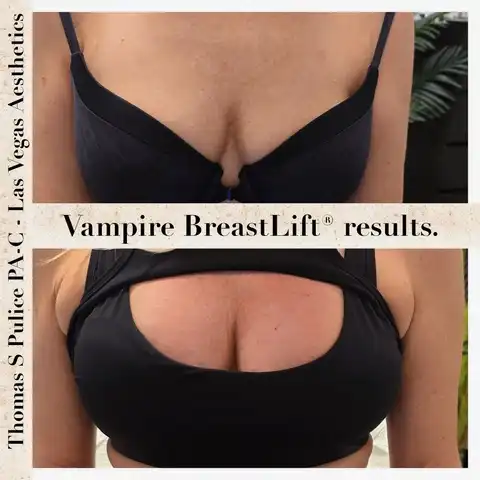 Vampire Breast Lift before and after results Las Vegas — natural breast enhancement with PRP at Las Vegas Aesthetics